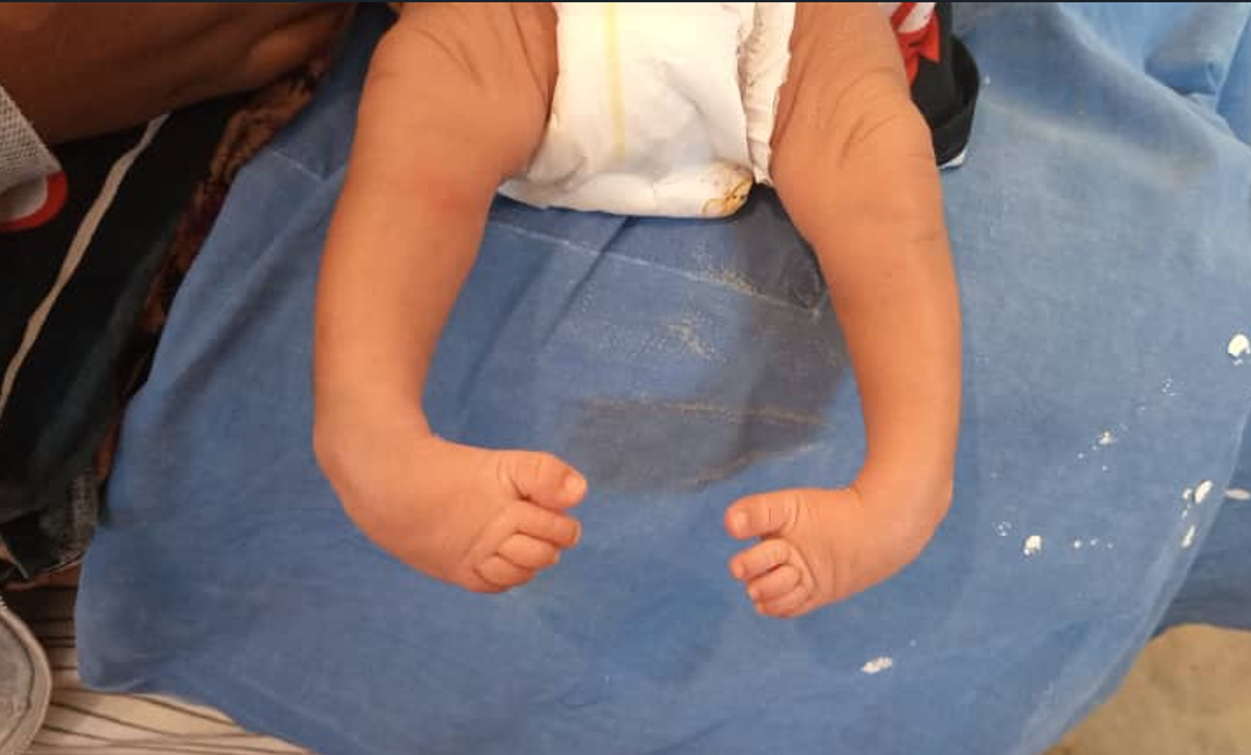 Clubfoot Project